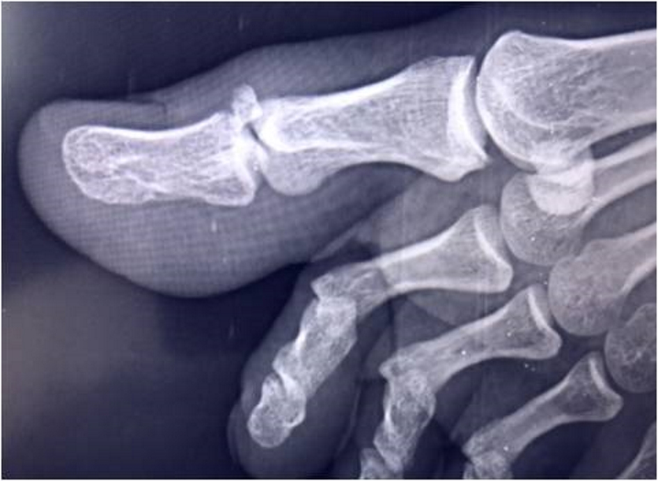 Great Toe Proximal Phalanx Fracture