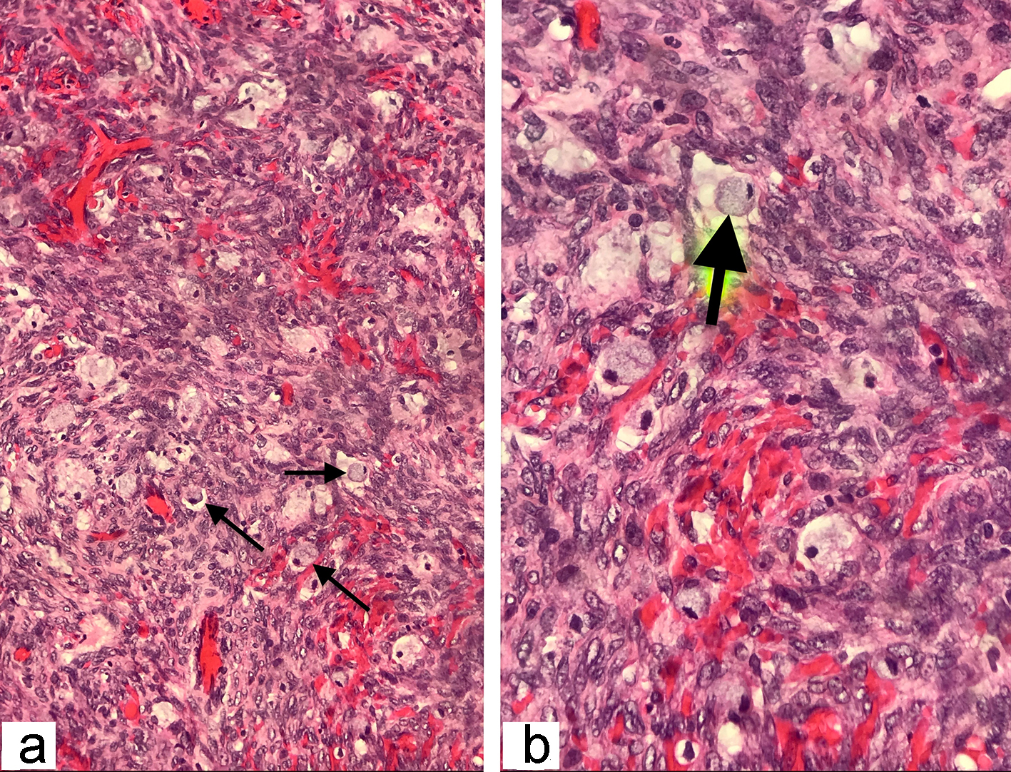 Gastric Signet-Ring Cell Carcinoma With Bladder Metastasis | Consultant360