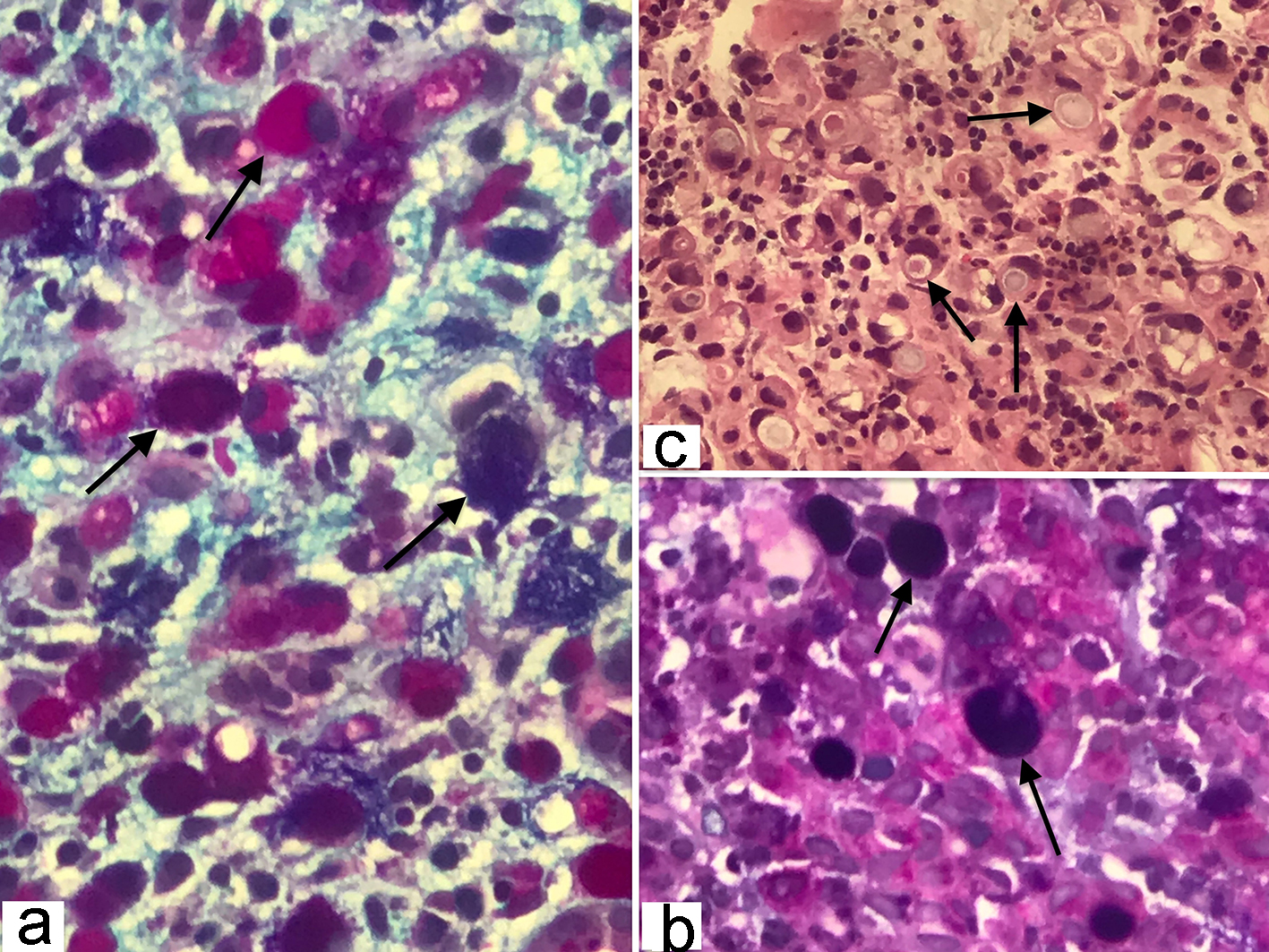 A Rare Case of Signet Cell Carcinoma of Transverse Colon in a Young Patient  With Ulcerative Colitis | Mohamed | Journal of Medical Cases