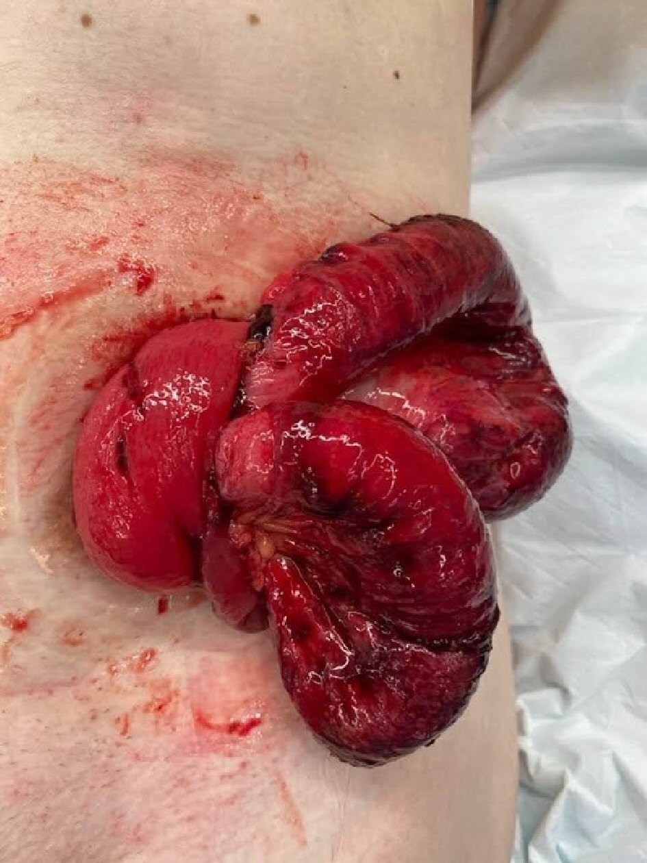 Colonic Perforation and Transstomal Evisceration of Small Bowel | Cecire | Journal of Current Surgery Colonic Perforation and Transstomal Evisceration of Small Bowel | Cecire | Journal of Current Surgery
